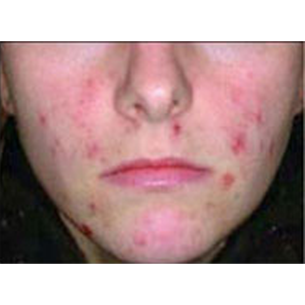 IPL Photofacial hyperpigmentation treatment before results