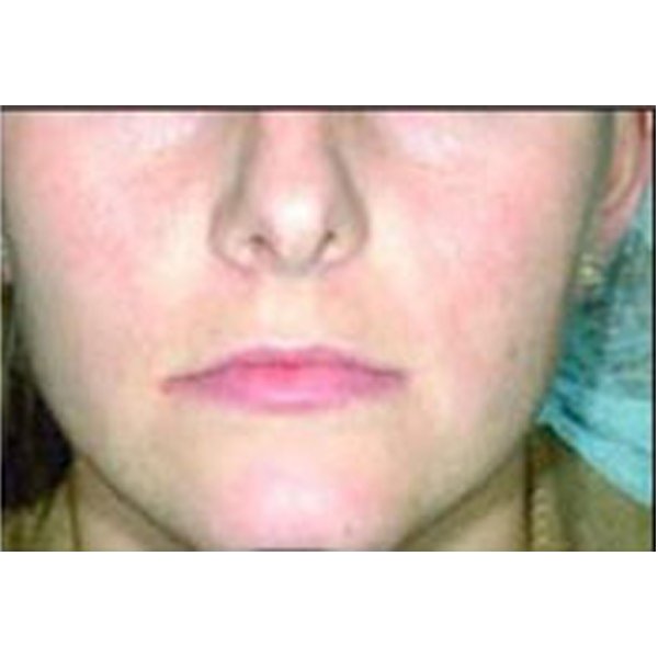 IPL Photofacial hyperpigmentation treatment after results