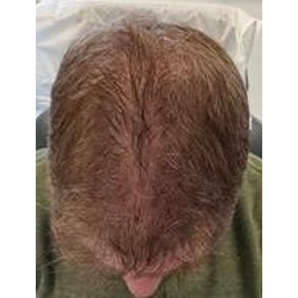PRP Therapy facial rejuvenation patient before results