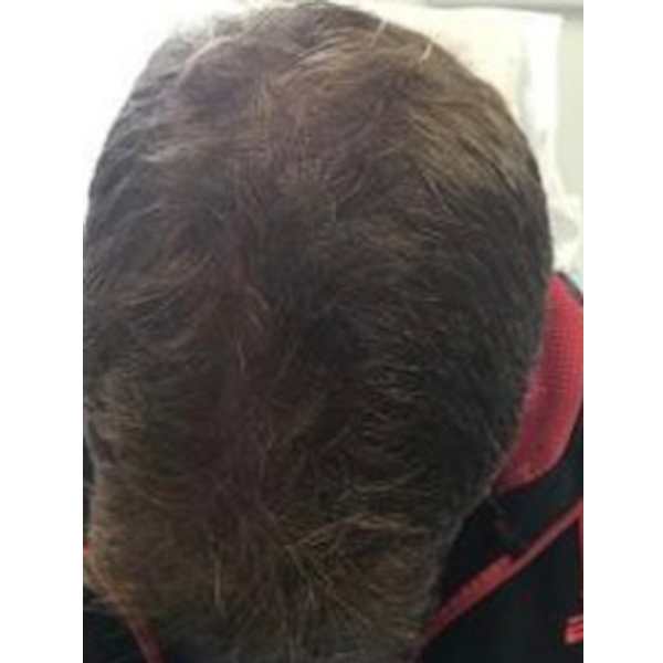 PRP Therapy facial rejuvenation patient after results