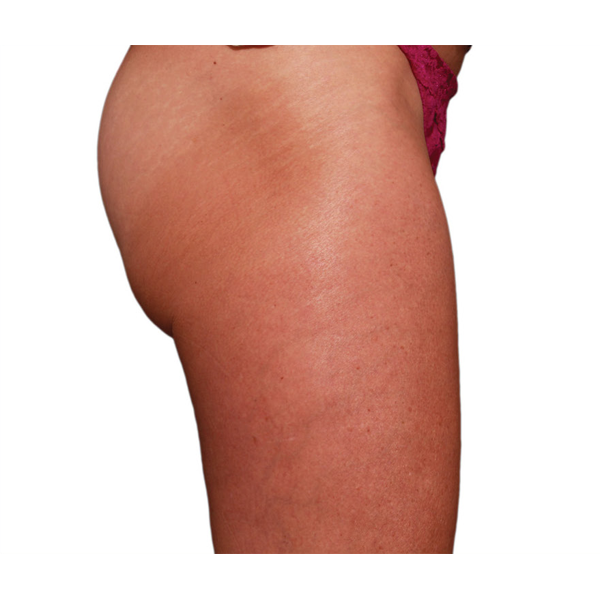 Venus Legacy Radiofrequency treatment before results