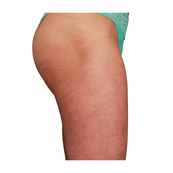 Venus Legacy Radiofrequency treatment after results
