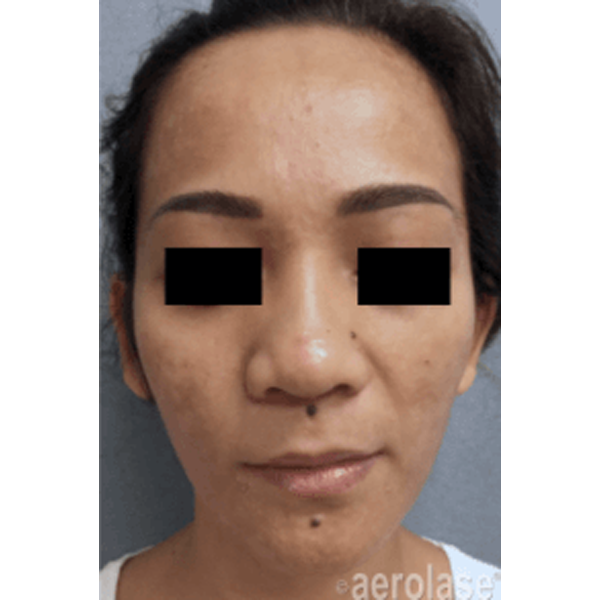 Aerolase Neo laser skin treatment after results