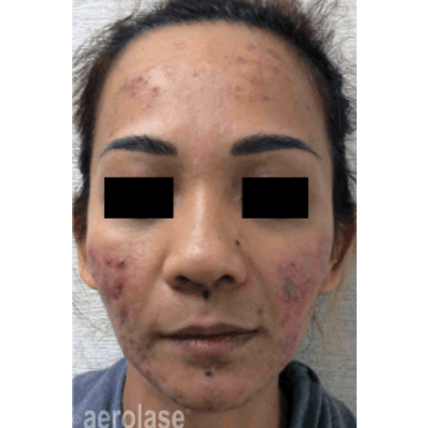 Aerolase Neo laser skin treatment before results