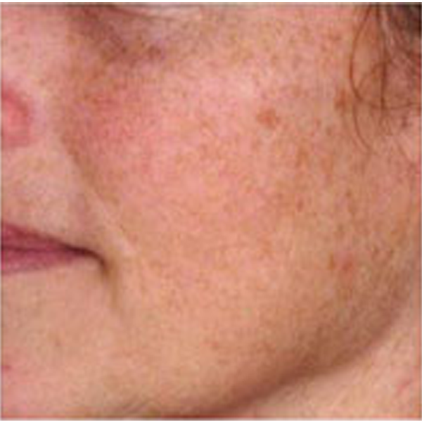 Ablative Yag Laser resurfacing treatment before results