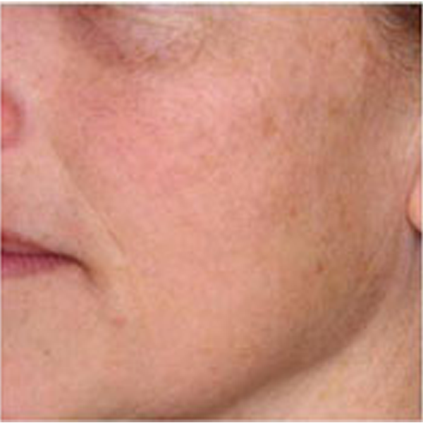 Ablative Yag Laser resurfacing treatment after results
