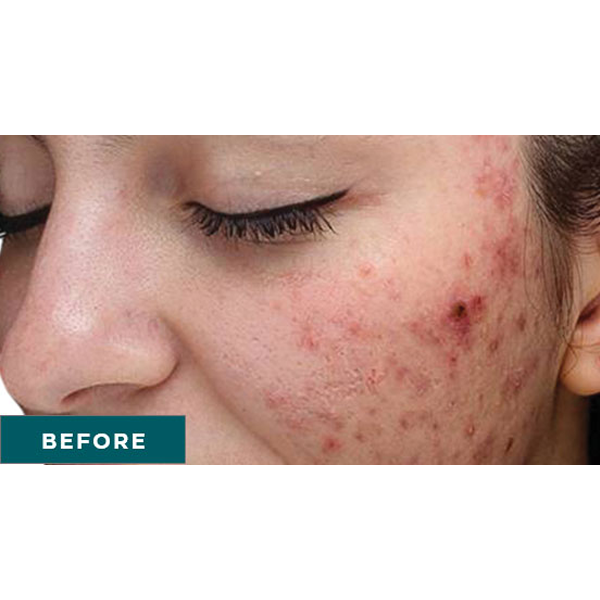 Chemical Peel skin resurfacing before results