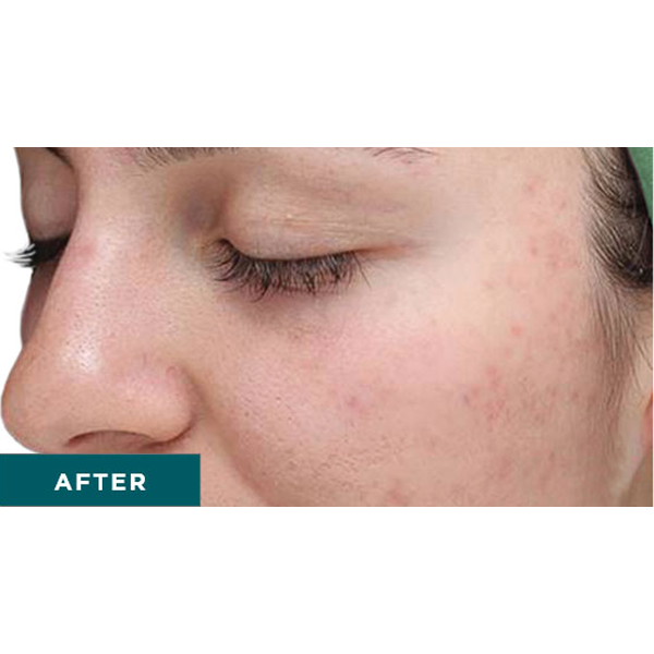 Chemical Peel skin resurfacing after results