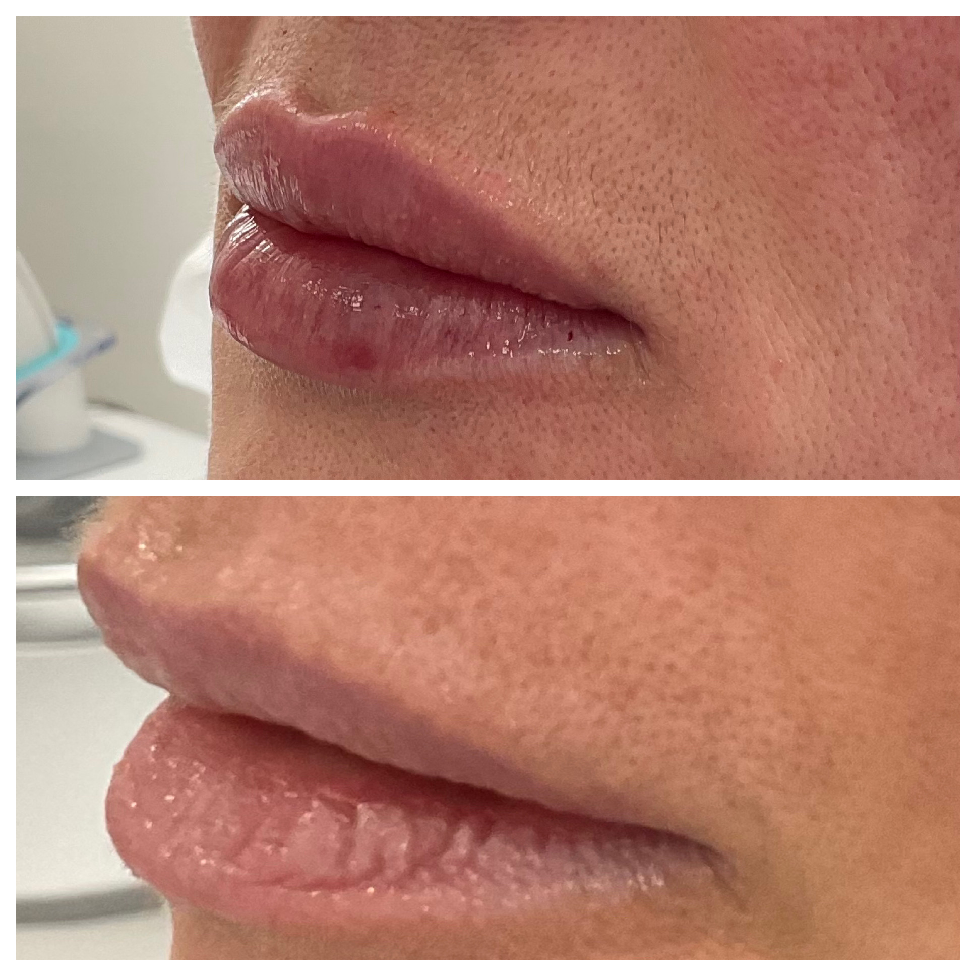 Hyaluronic Acid filler facial contouring results
